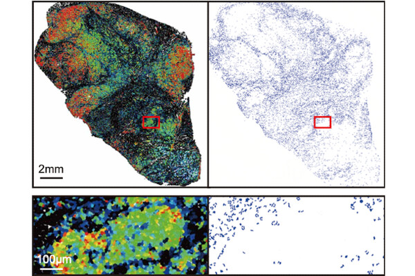 four panels show a cancerous tumor with some portions labeled in red, green, and blue, and a close up image of part of it