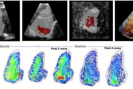 <p>Three-dimensional streamlines of blood flow (below) in the right ventricle of the heart during a heartbeat acquired from 3D echocardiography data. Yasaman Farsiani / UCI</p>
